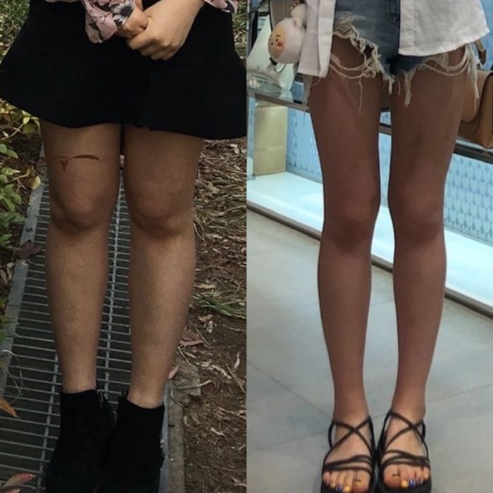 SNPE 전과 후의 다리 라인 비교 사진